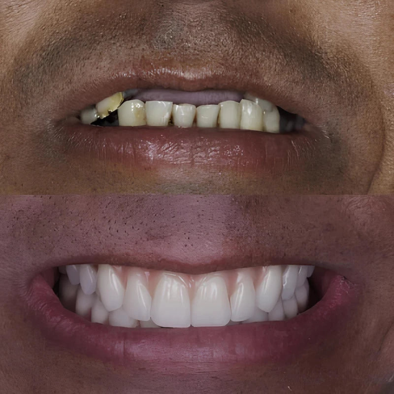 Dentadura de Silicone FIX Ajustável e Adaptativa